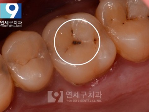 치아우식증(충치) 초기 단계, 당일 레진 치료로 대처 가능할까